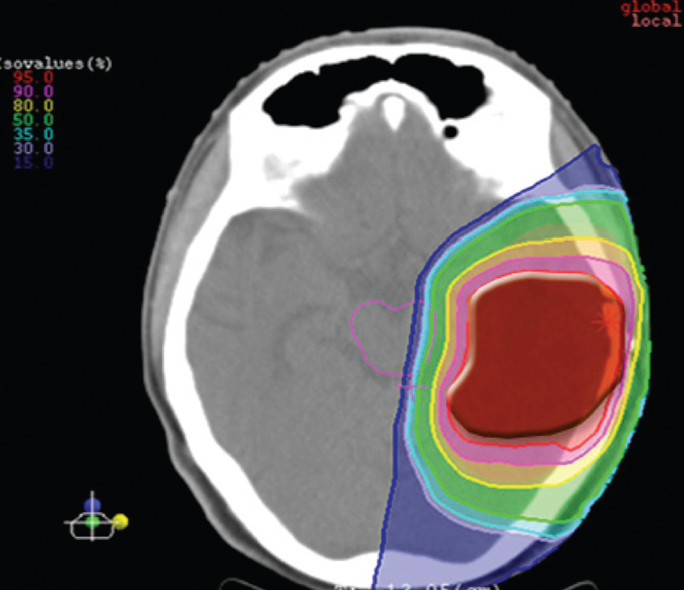 Benefits of proton therapy Beaumont Health