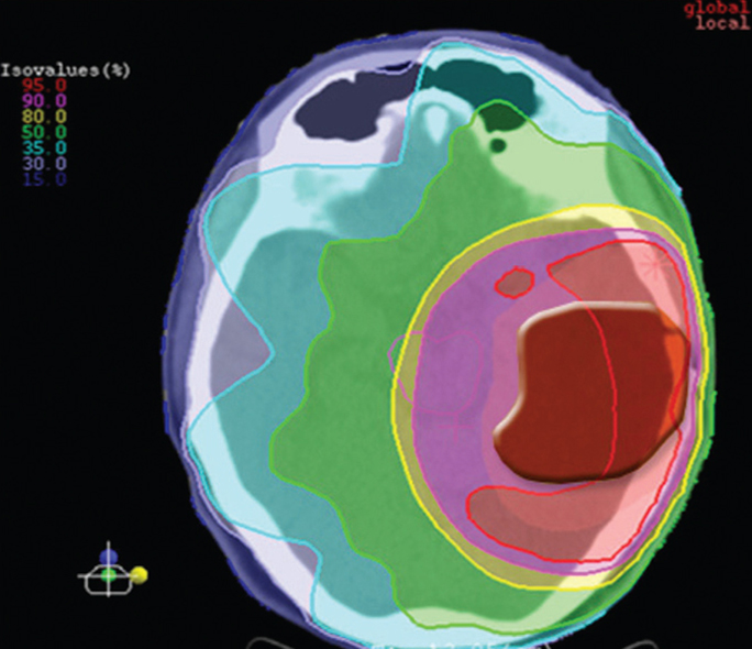 Benefits of proton therapy Beaumont Health