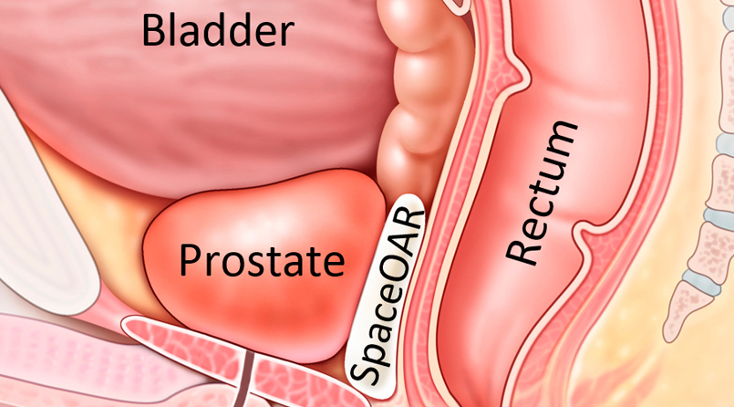 prostate radiation beads