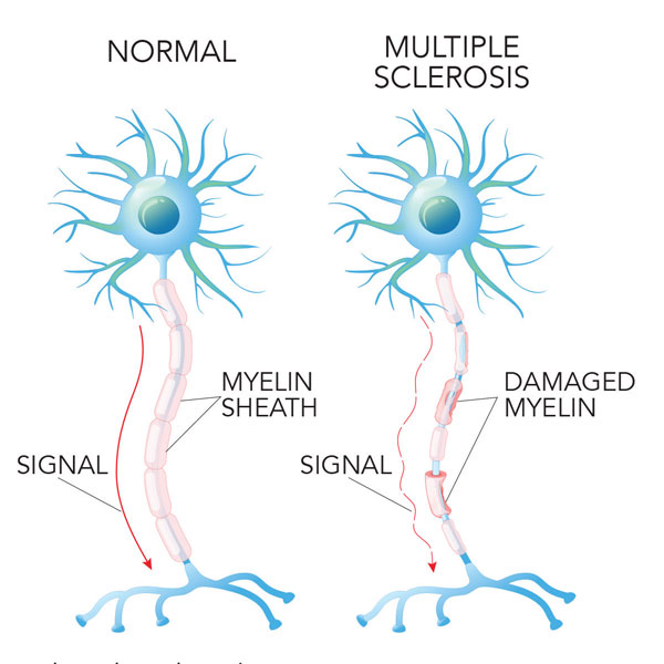 Multiple Sclerosis Symptoms And Causes Neurology Beaumont Health