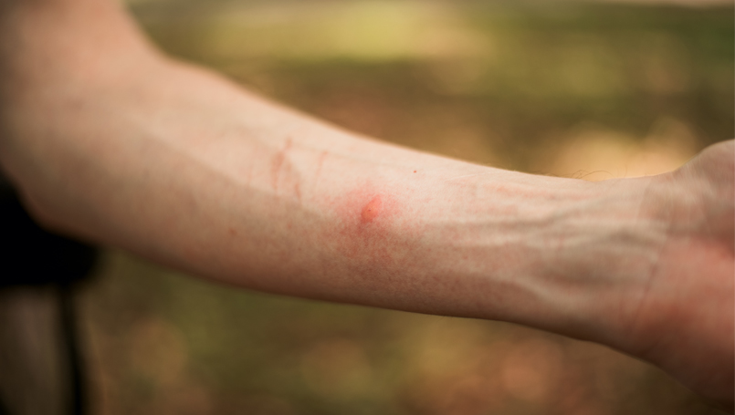 Woman itching and scratching her chest caused by insect bites