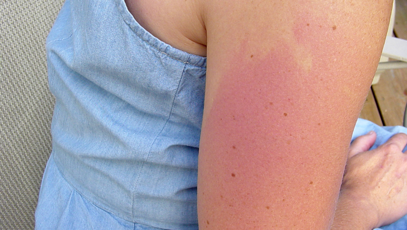 rash from life jacket treatment