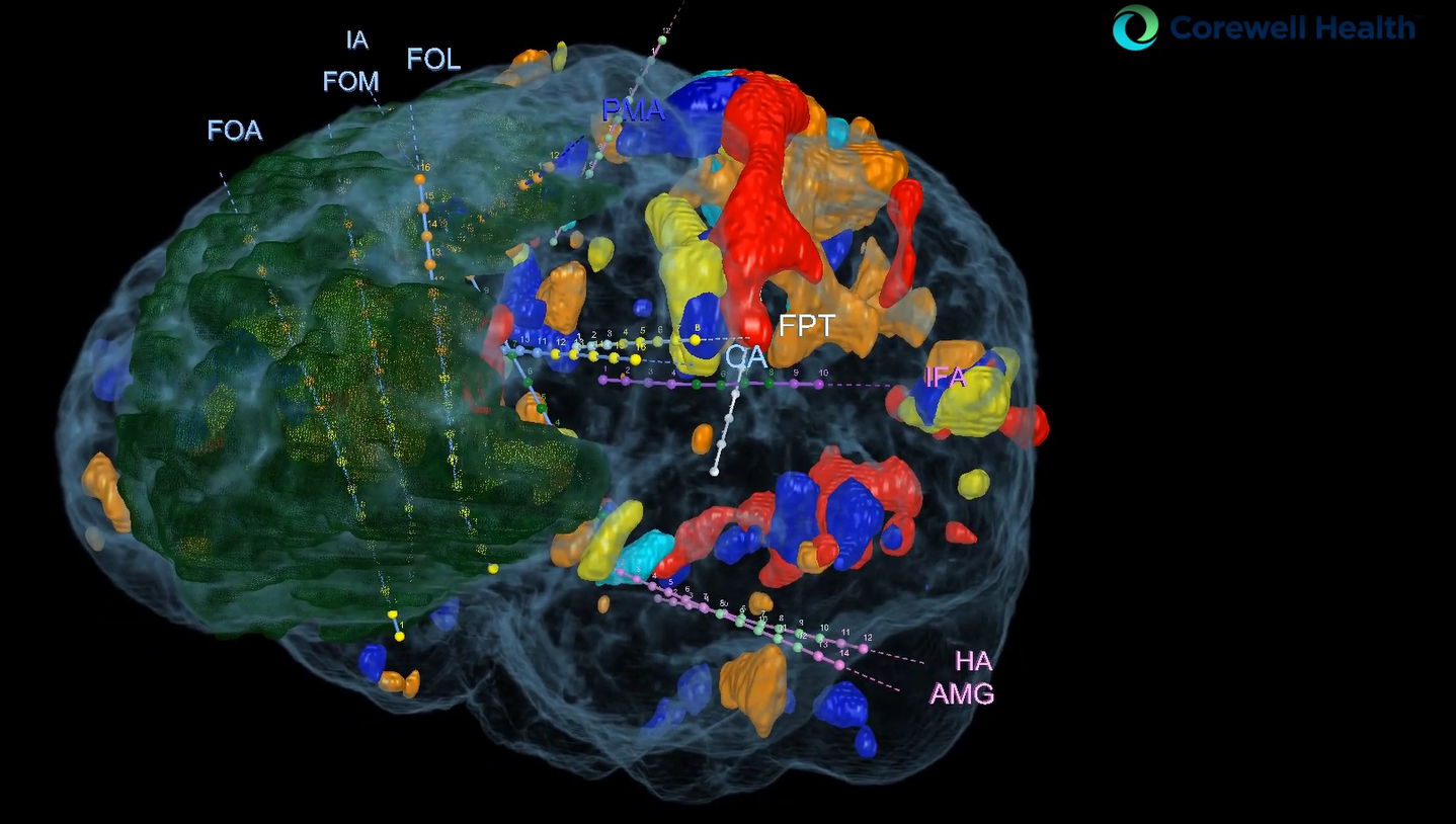 Corewell Health Uses Virtual and Augmented Reality in Neurosurgery