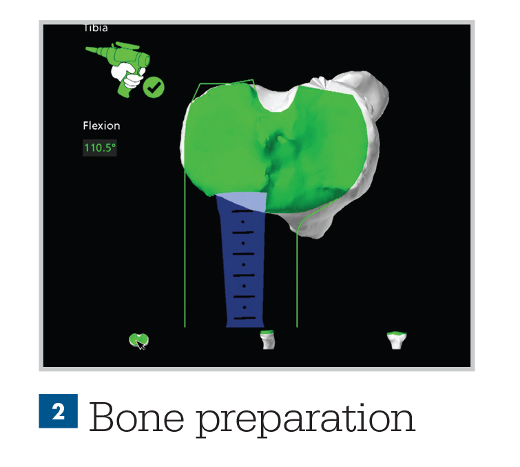 Mako Total Knee Replacement Surgery Beaumont Health