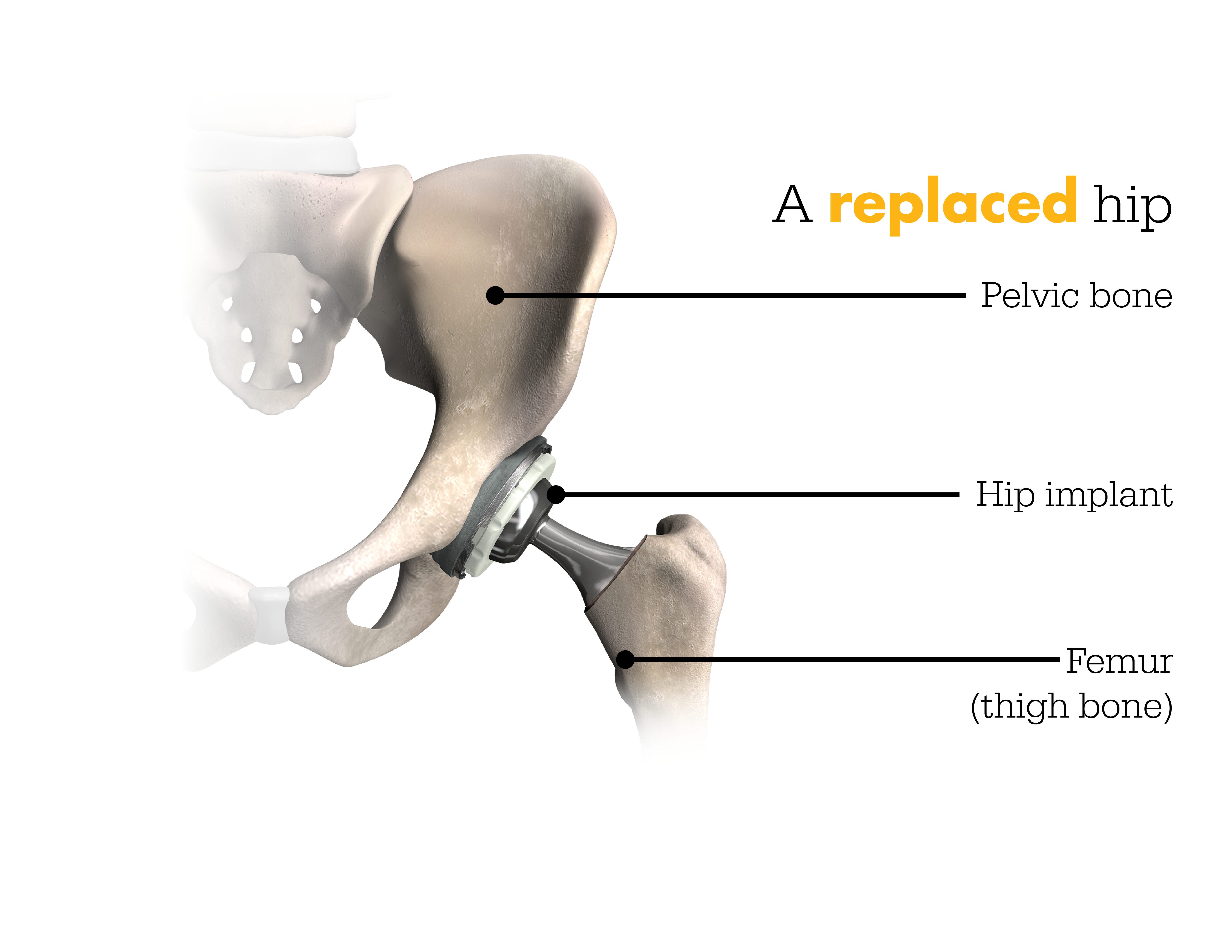 Beaumont Health Mako Robotic Arm Assisted Technology For Total Hip