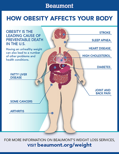 lack of exercise causes obesity