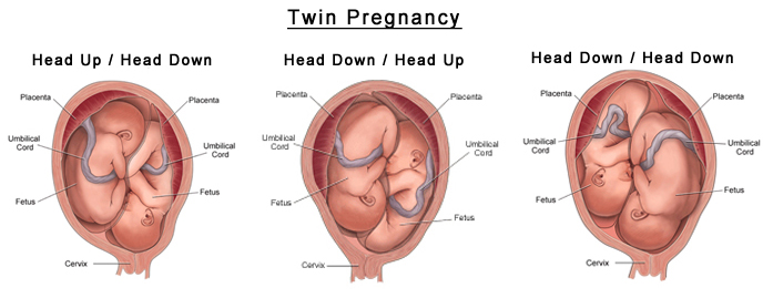multiple birth